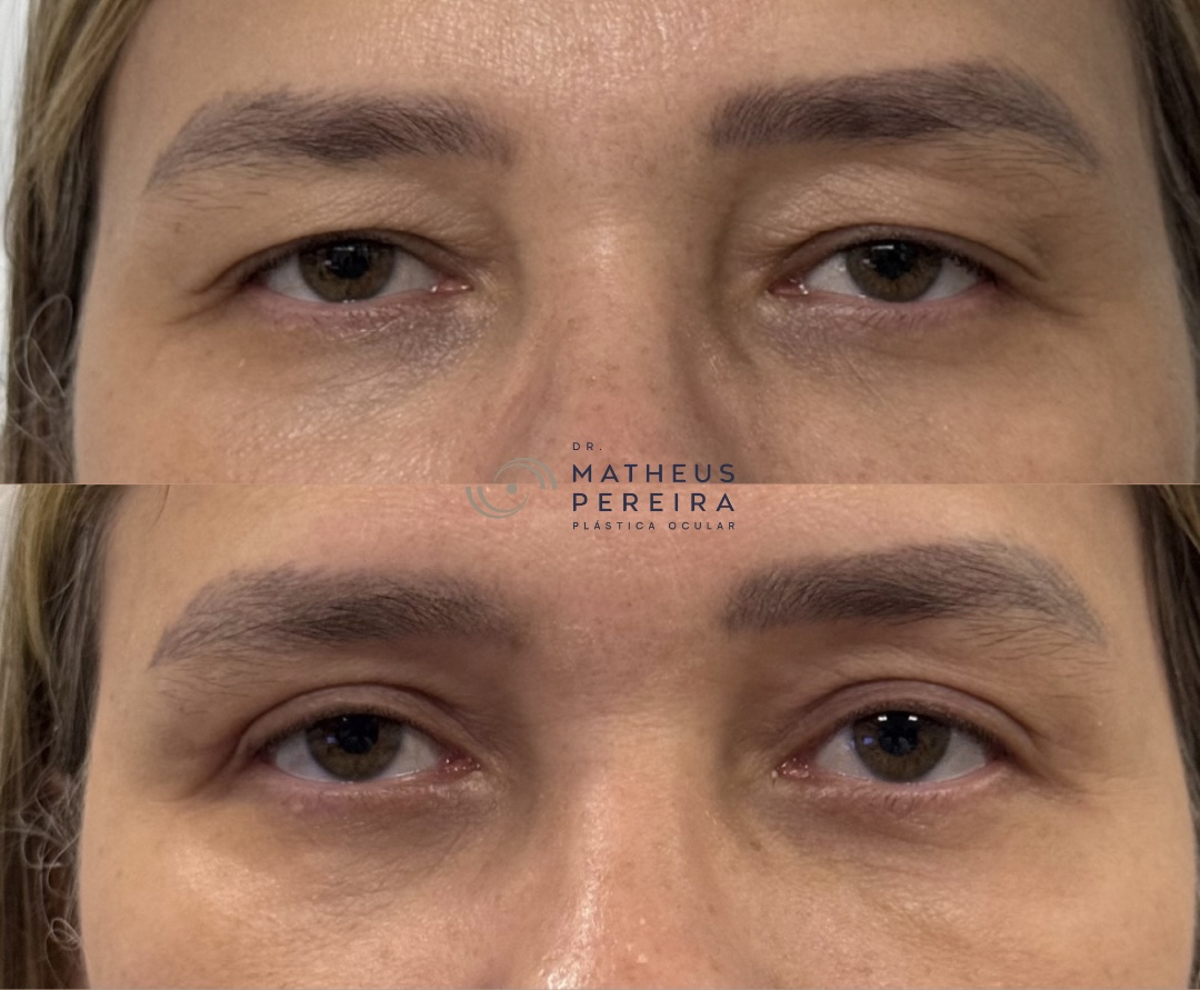 Antes e depois 1